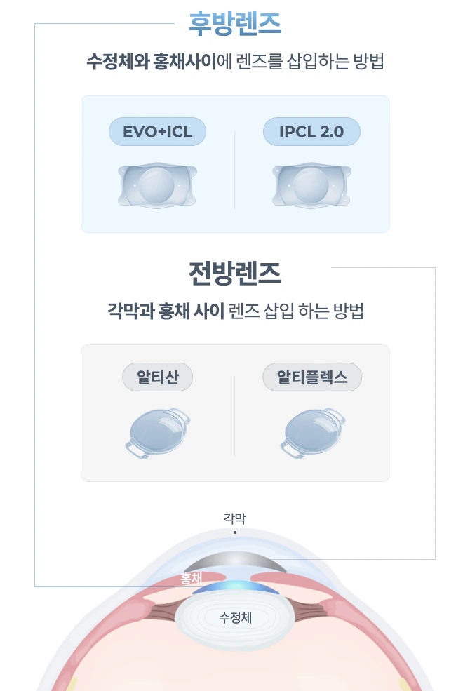 후방렌즈와 전방렌즈 비교 : 후방렌즈는 수정체와 홍채 사이에 렌즈를 삽입하는 방법이고 전방렌즈는 각막과 홍채 사이에 렌즈를 삽입하는 방법