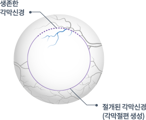 강남서울밝은안과