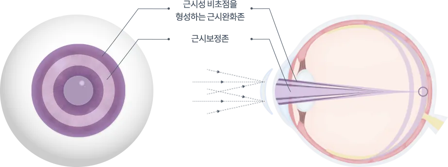 강남서울밝은안과