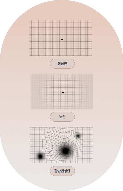 강남서울밝은안과