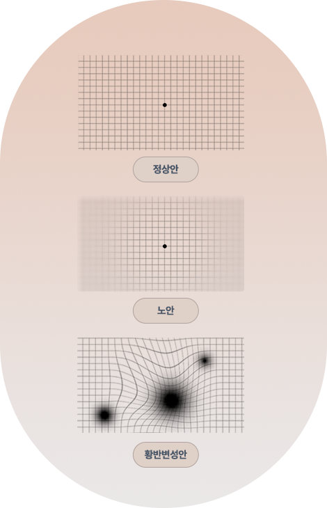 강남서울밝은안과