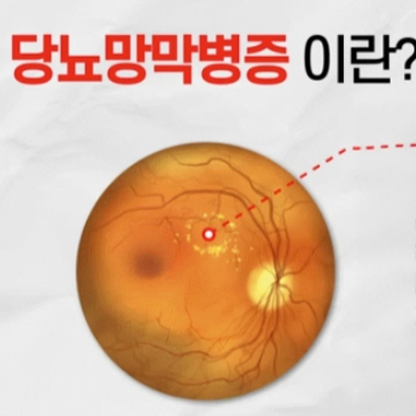 강남서울밝은안과